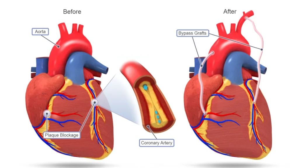 CABG