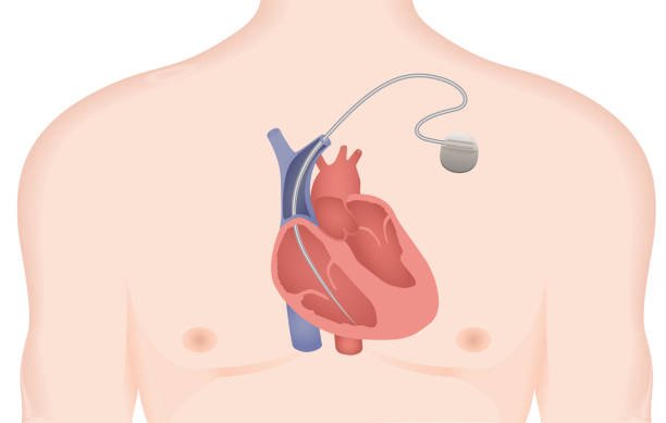 Coronary Angiography