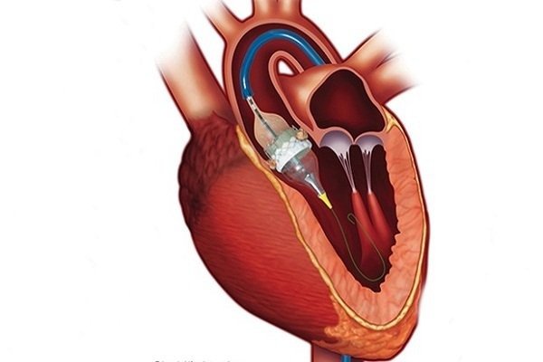 Best TAVR Surgery Doctors in Indirapuram